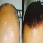 Business 5 image BEACON HAIR RESTORATION CLINIC Health & Medicine in Sandyford D